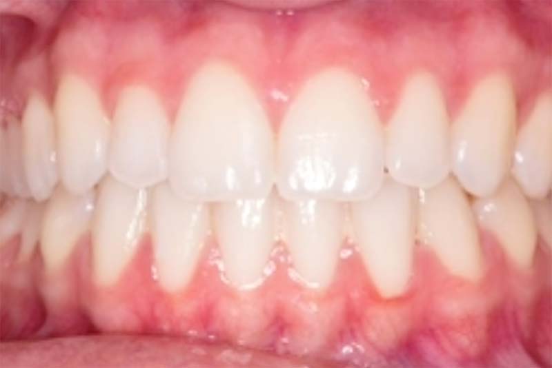 Smile Makeovers