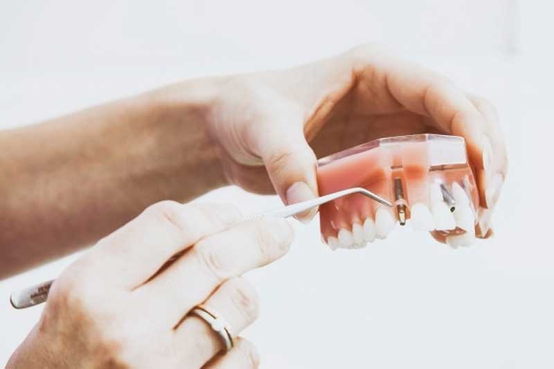 Dental Implants